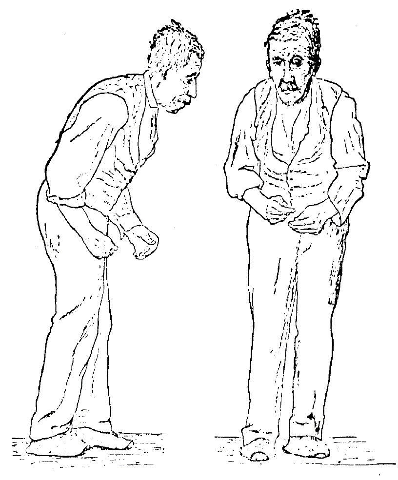 Sir William Richard Gowers Parkinson Disease sketch, showing Parkonsonian gait and typical stance.